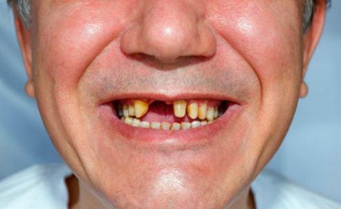 中年牙齿松动脱落是什么原因,年龄大牙齿有掉落有松动怎么修复