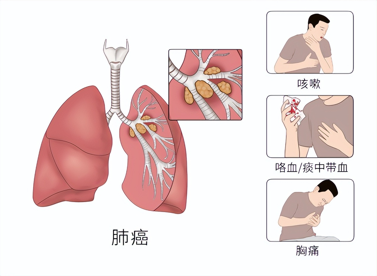 19种癌的早期信号和筛查建议——早知道能救命！