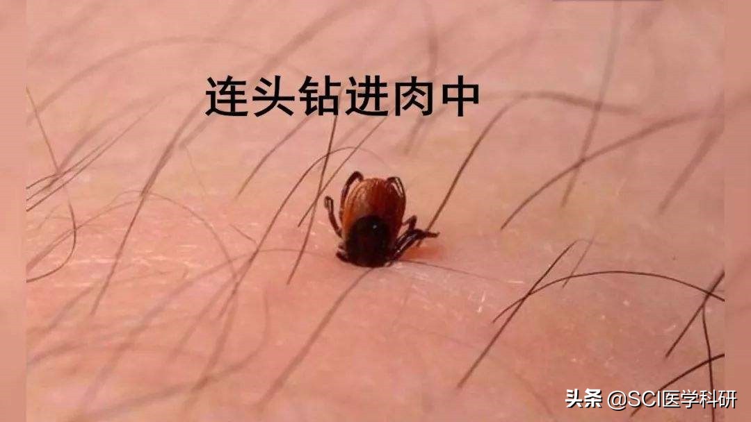 男子户外踏青被蜱虫叮咬高烧不止,男子被蜱虫叮咬住进icu