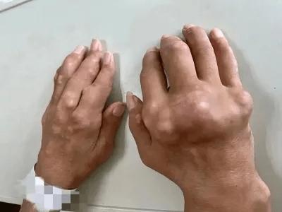 痛风老人吃哪种止痛药好,痛风吃止痛药有什么坏处