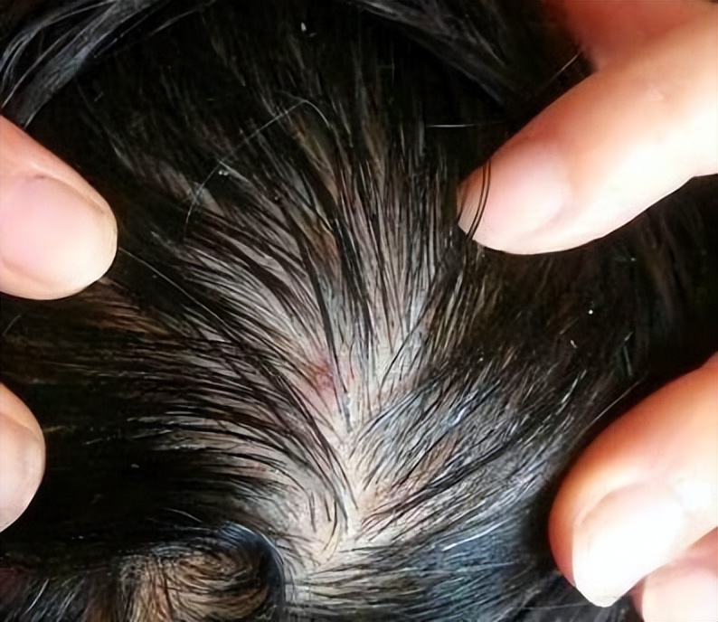 头皮经常起疙瘩有脓包是什么原因,头皮总是长疙瘩或脓包是什么原因