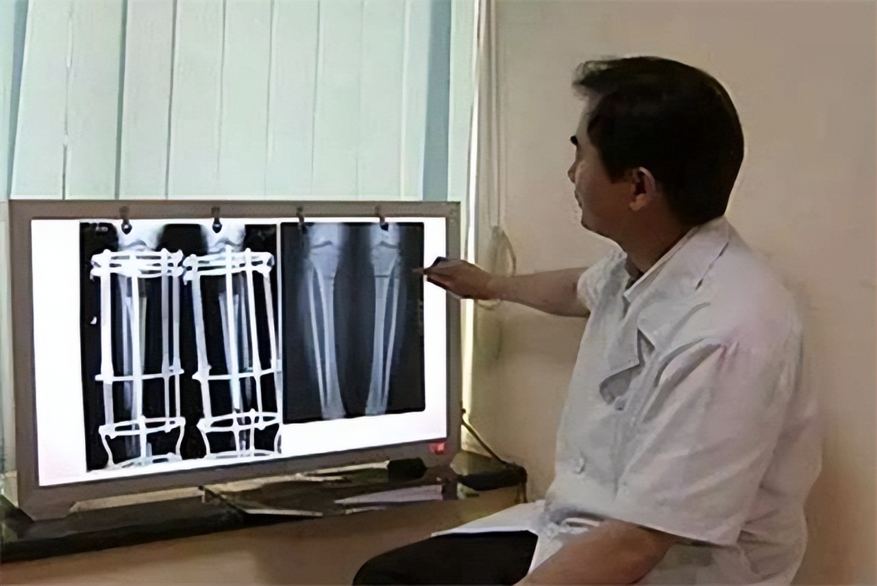 断骨增高的李亚诺是哪里人,李亚诺截骨长高是真人真事吗