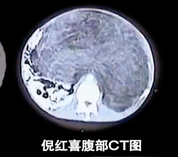 50岁大爷查不出五脏六腑,50岁大爷去体检找不到器官