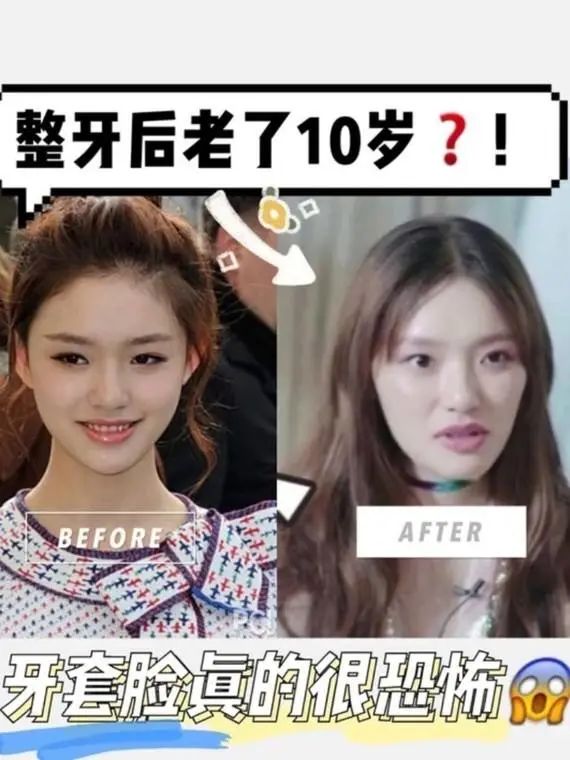 整牙亲身经历分享一下,整牙的经历分享