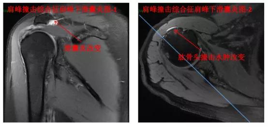 老是肩膀难受咋回事,肩膀痛要怎么缓解