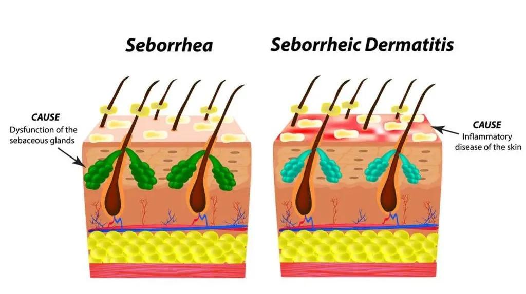 脱发跟头屑的关系,脱发和头屑的关系