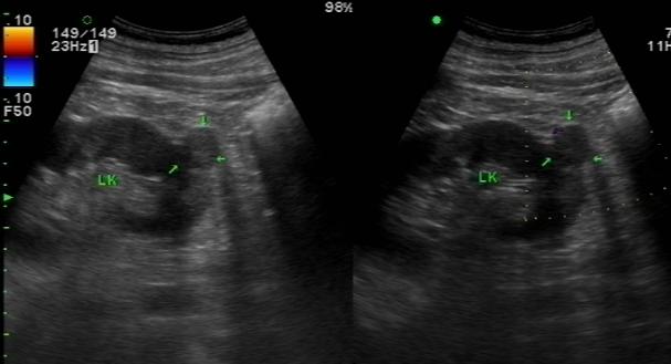 腹部彩超能查出什么病,腹部彩超能查出什么癌症吗