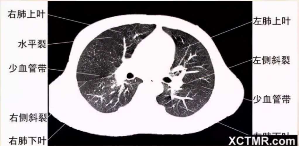 胸腹部盆腔ct主要检查什么,女性盆腔ct断层解剖结构图