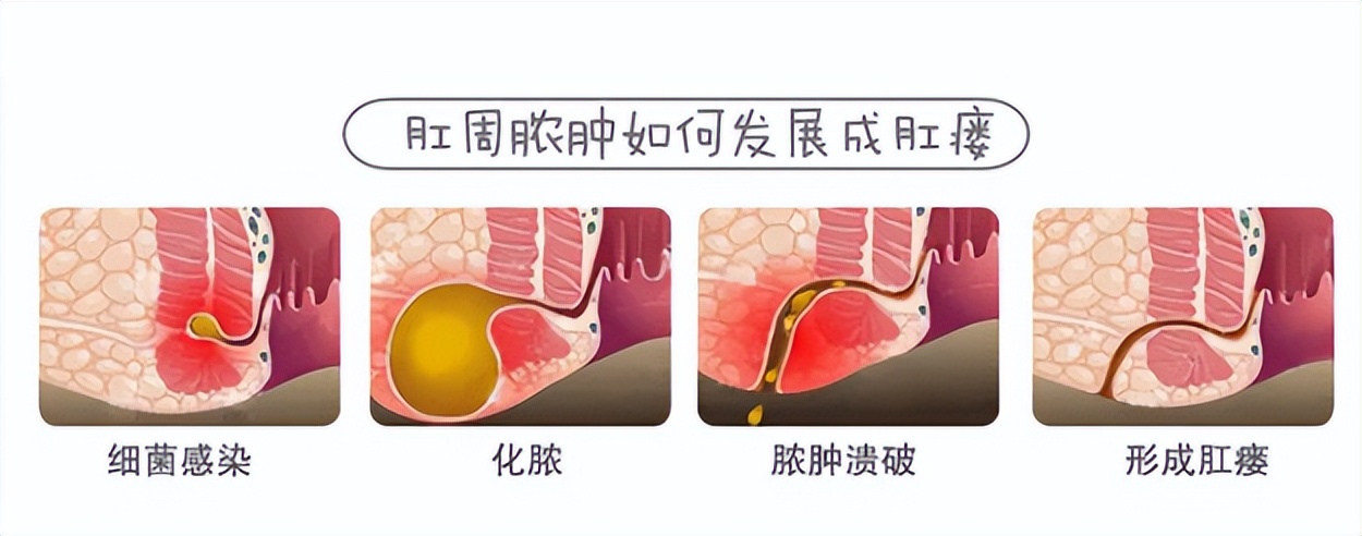 别说你会擦屁屁！43岁衢州大哥因这里没清理干净，住院了！