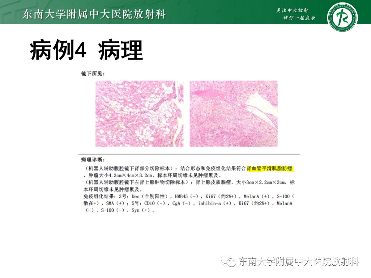 周利群谈肾嫌色细胞癌ct特点,好文分享值得深思