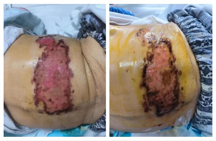 老年人得疱疹两个月了手上还是疼,老年人得了疱疹隔三差五好不了