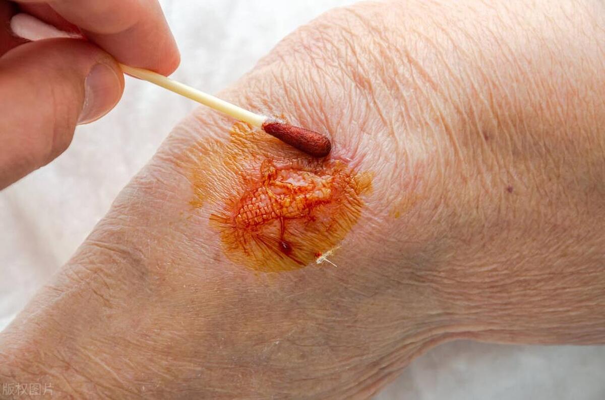 上肢骨折术后深静脉血栓原因,下肢骨折病人深静脉血栓预防方法