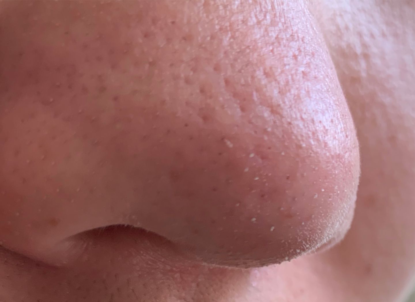 鼻子上油脂粒去除后怎么收缩毛孔,鼻子上长了个类似痘的东西