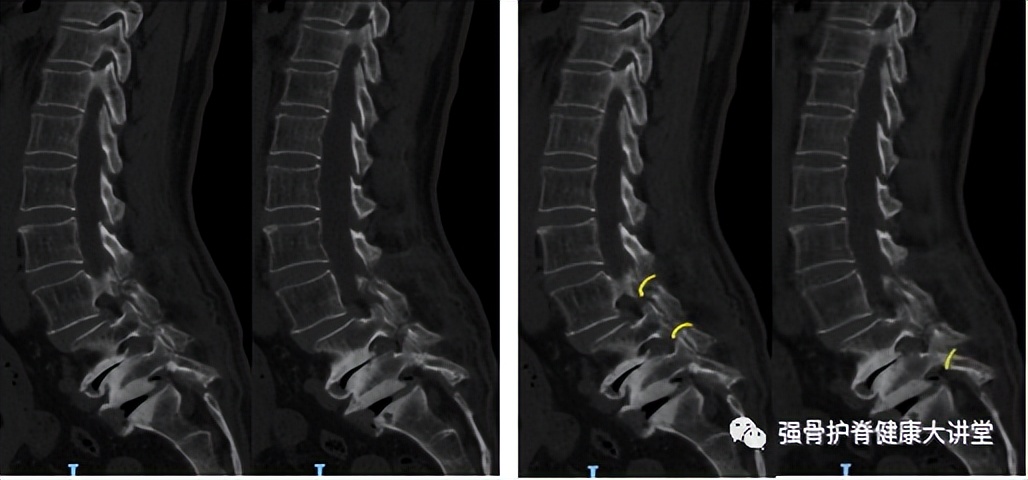 「医学科普」腰椎峡部裂可以同时发生在多个节段