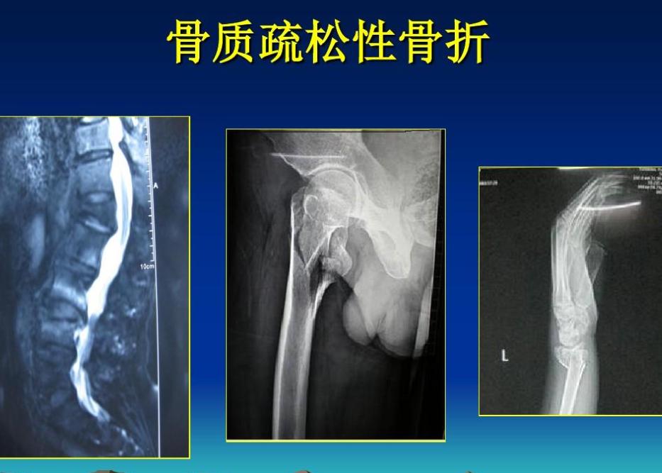 儿童骨密度检测中bmi正常范围,34岁骨密度检测说骨质疏松怎么办