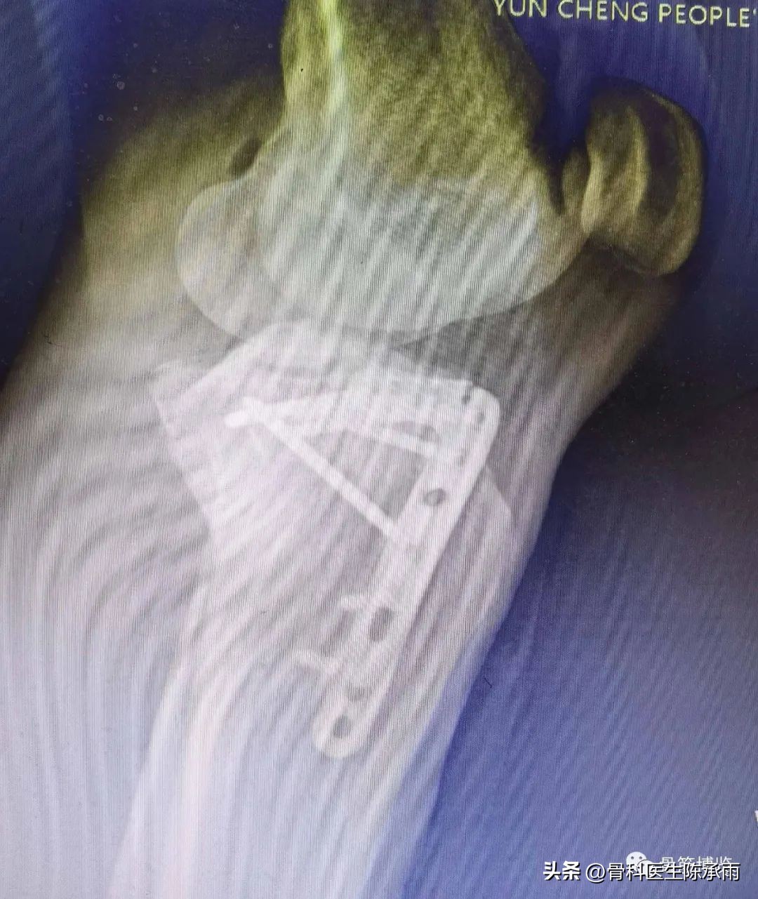 膝关节胫骨平台骨折,最近胫骨平台骨折视频