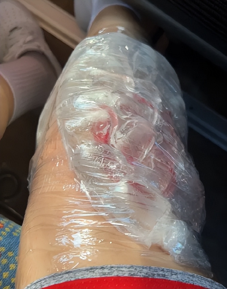 运动受伤擦啥药,受伤恢复期运动后是冰敷还是热敷