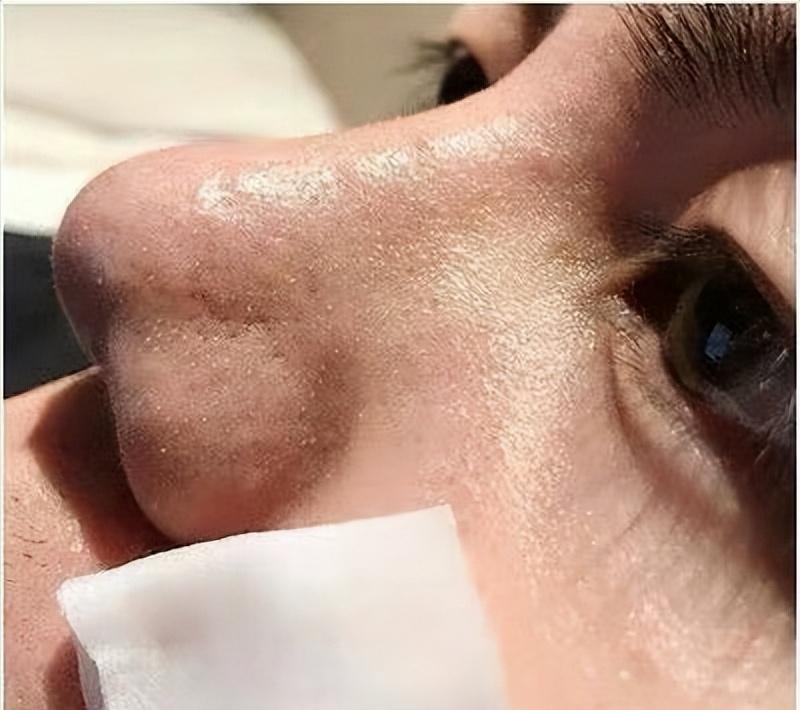 去鼻子上的黑头最好的方法,去鼻子上黑头的有效方法