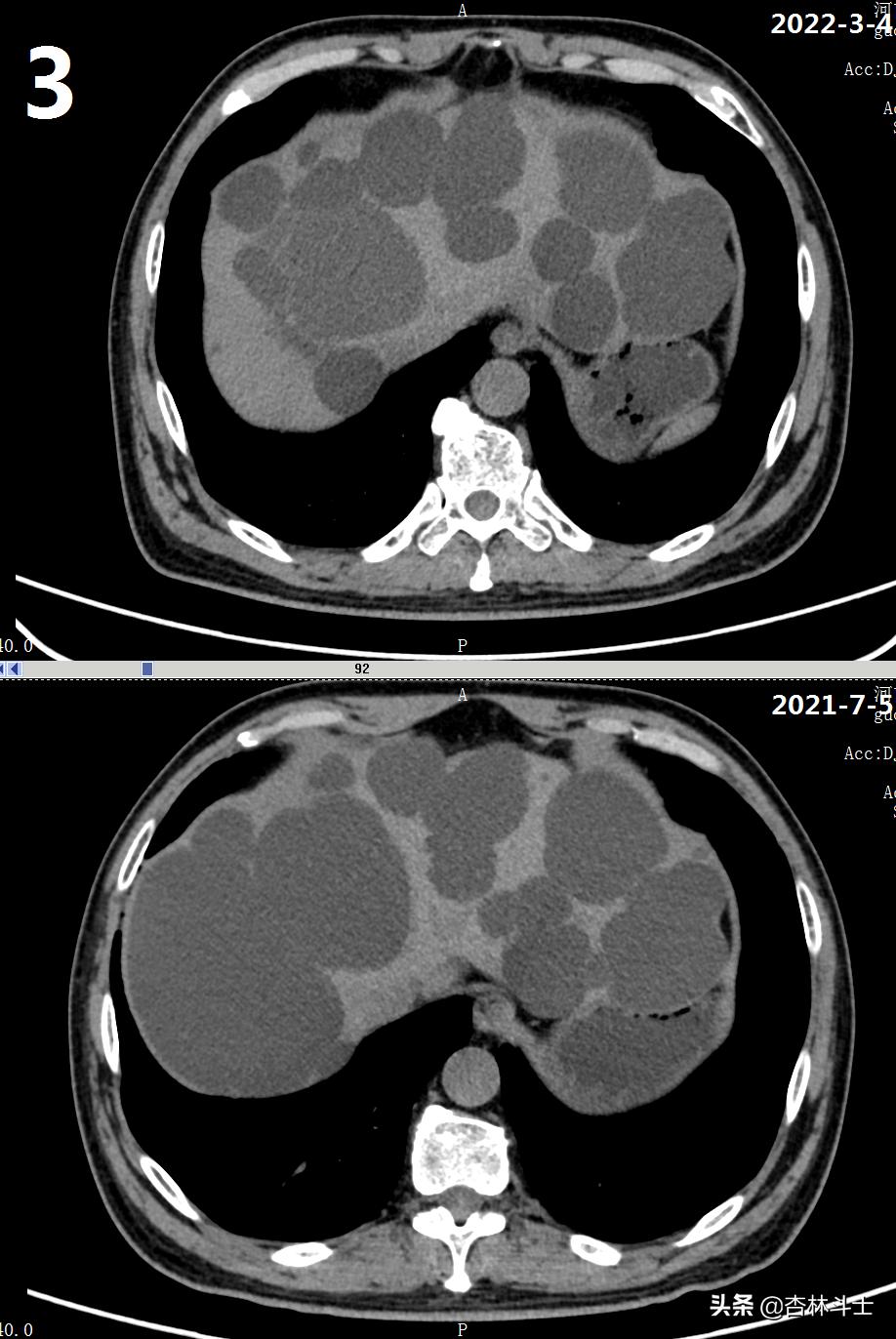 64岁银行职员患肝囊肿,CT引导下细针穿刺抽吸酒精硬化解决大问题