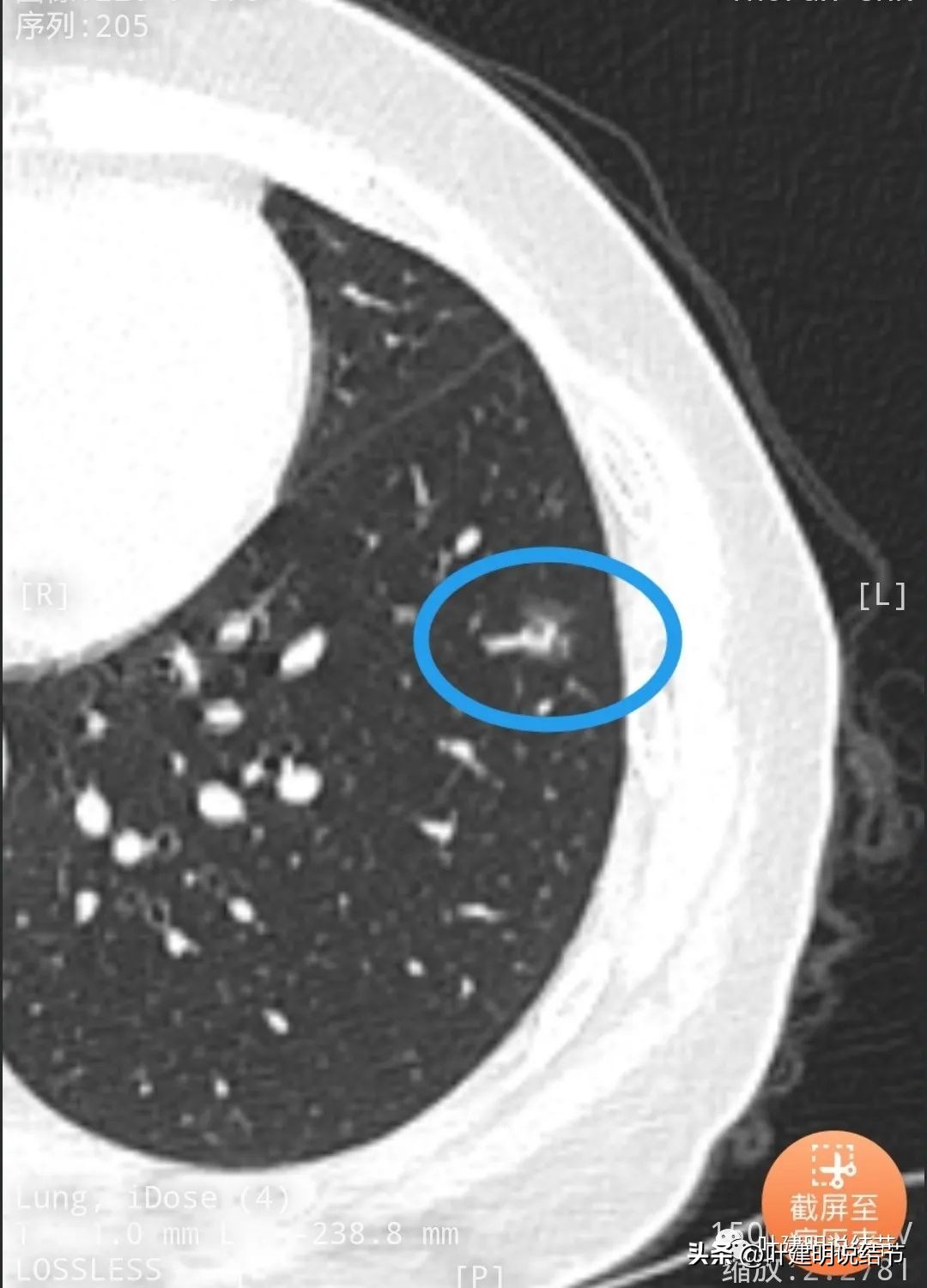 辽宁省肺结节手术哪家医院好,辽宁肺结节手术医院
