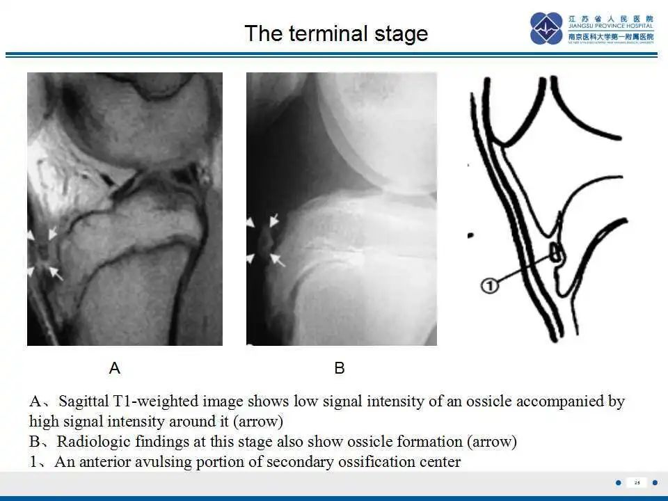 胫骨结节软骨炎要怎么治疗,胫骨结节骨软骨炎会癌变吗