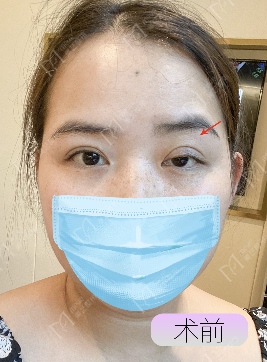 眼睛一大一小的解决方法,眼睛一大一小严重怎么办