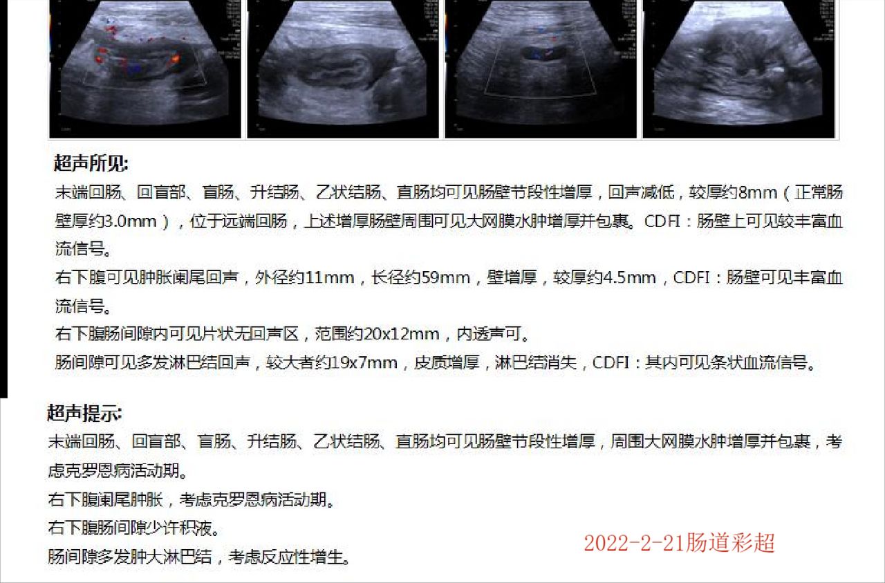 克罗恩肠粘连肠瘘能自愈吗,克罗恩出现肠瘘如何治疗