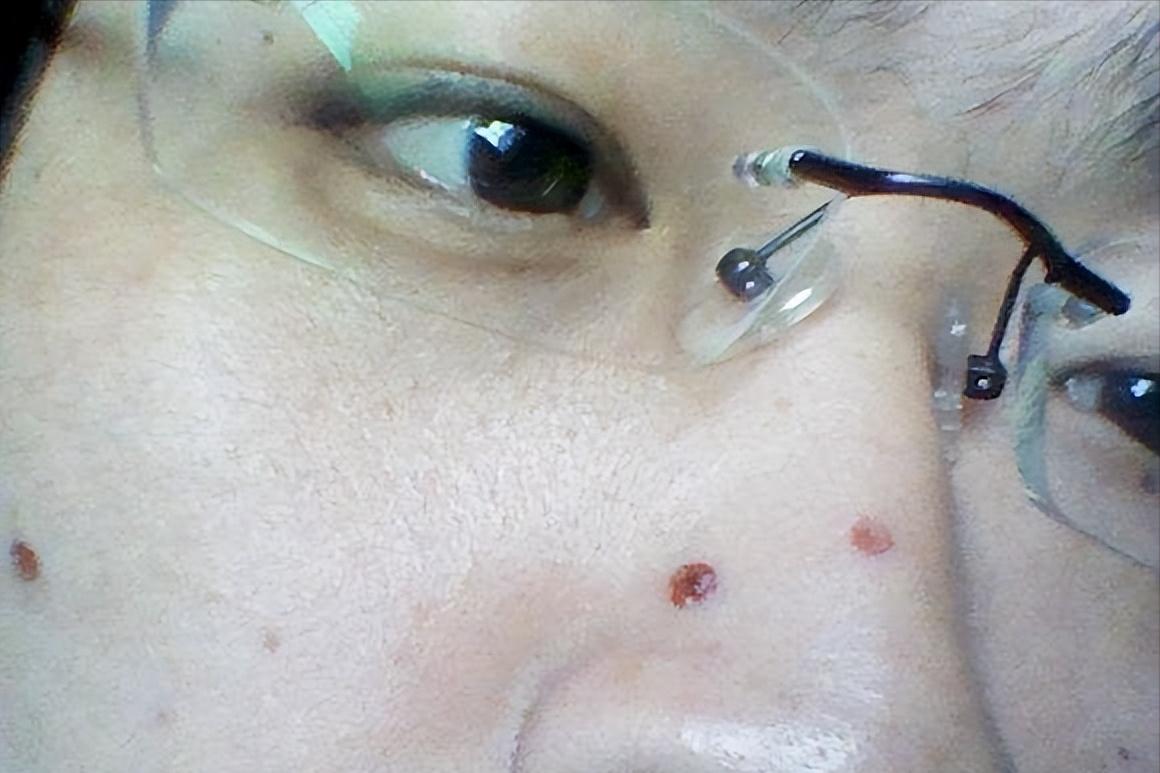 可以一个人取痣吗,点痣如何不翻车