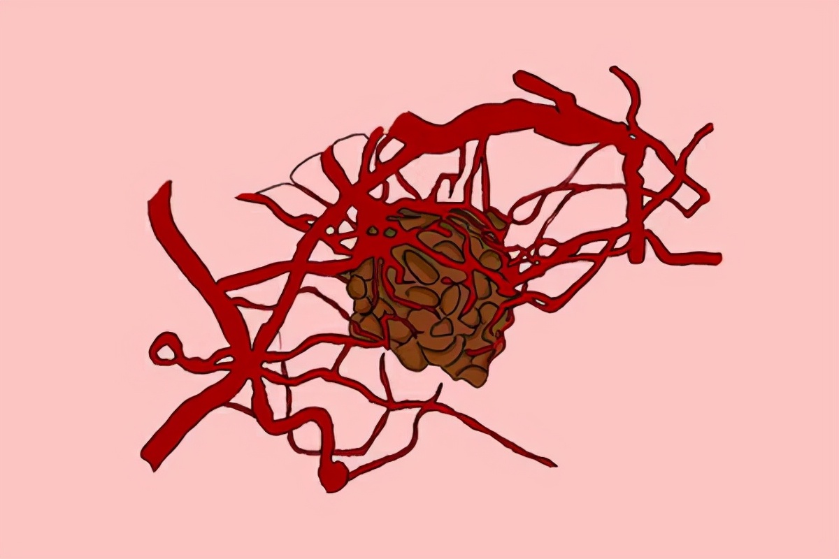 如果癌症转移骨髓有什么症状,癌症一旦转移到骨头生存期