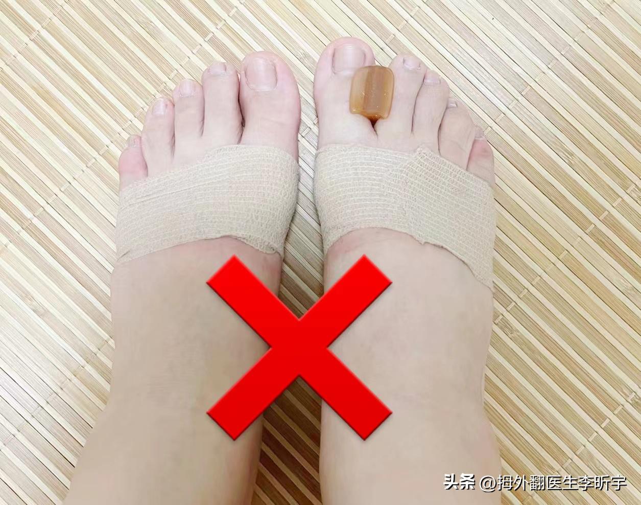 遗传性拇外翻能矫正过来吗,遗传性脚趾拇外翻怎么避免