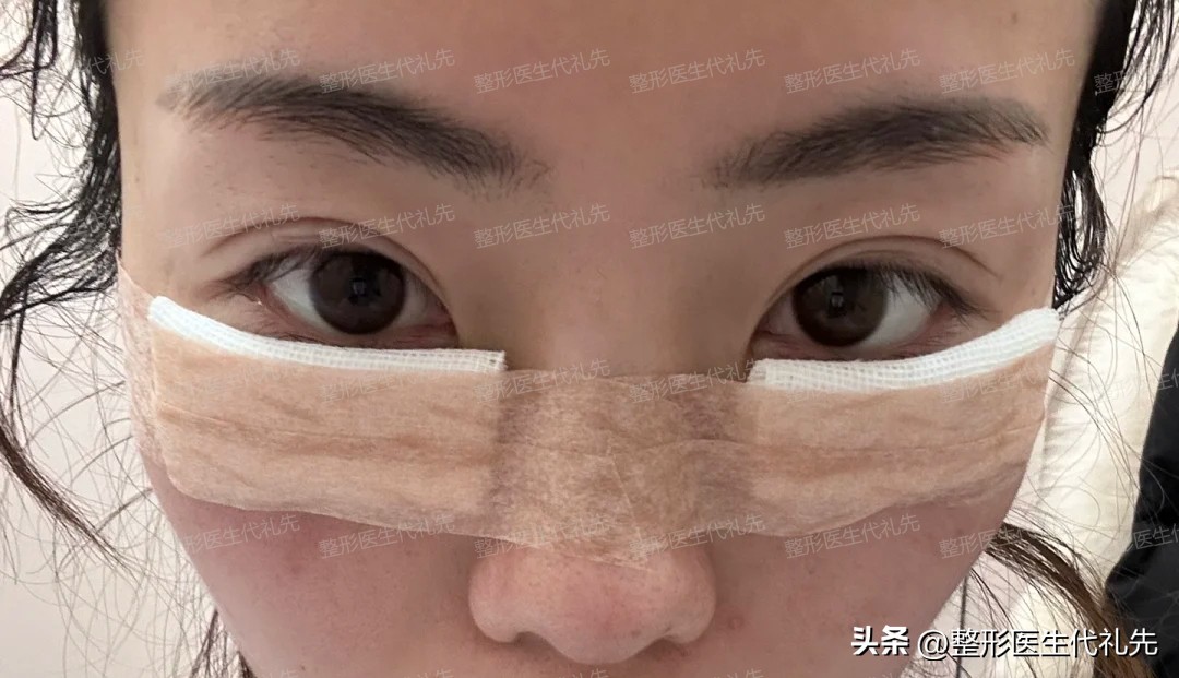 眼袋内切手术后眼袋不对称,年轻人内切眼袋手术恢复期7天图