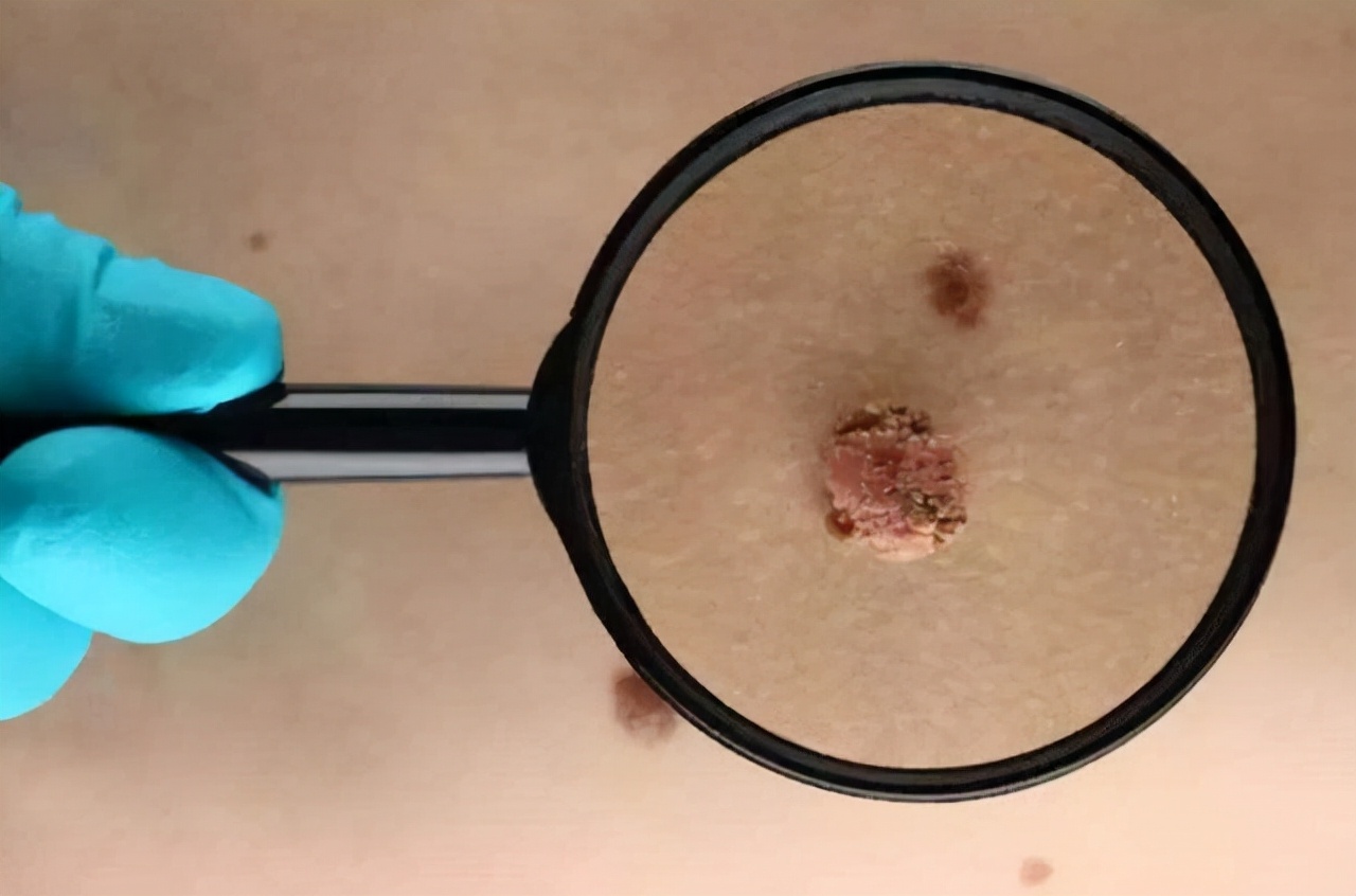 怎么在医院确定黑痣是不是良性的,黑痣隆起挂什么科检查