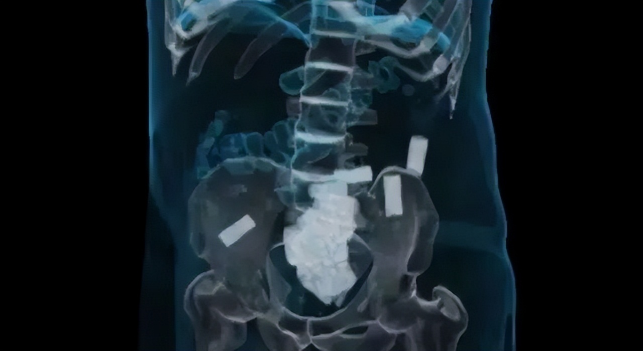 人体藏毒案,揭秘人体藏毒