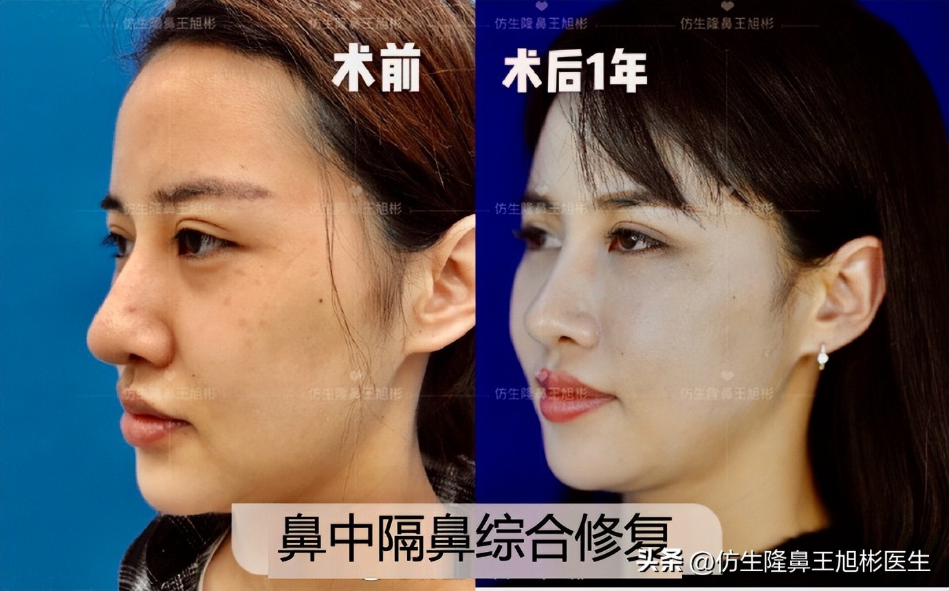 窄鼻子如何通过鼻整形来矫正,宽鼻子矫正方法