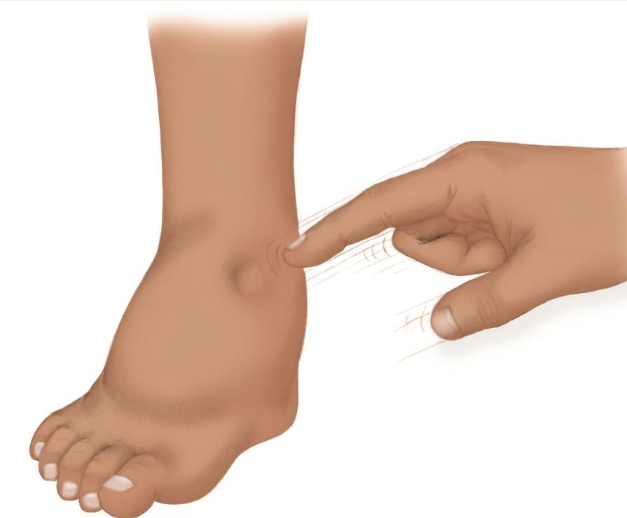 水肿怎么看？2方法评估水肿分级，4招快速消水肿