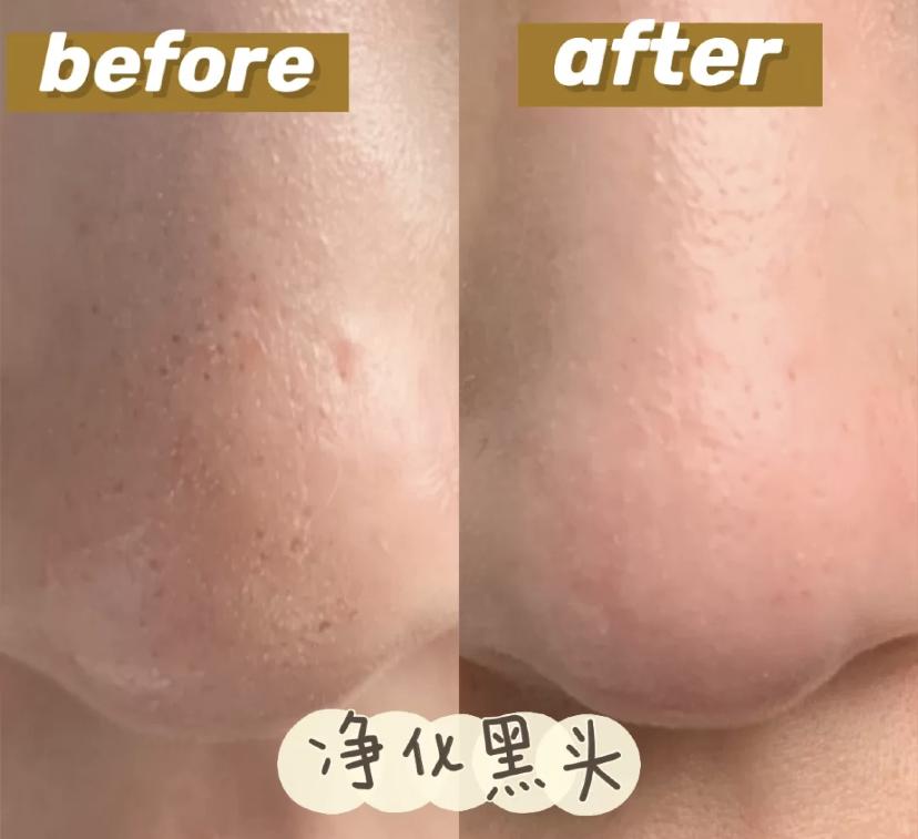 科颜氏白泥面膜清洁去黑头125ml,科颜氏白泥面膜真的能去黑头吗