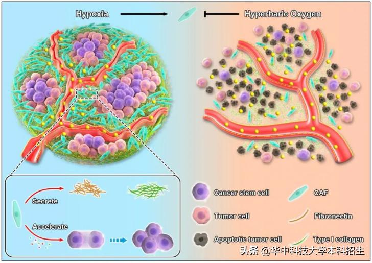 胰腺癌突破性进展,胰腺癌研究最新成果