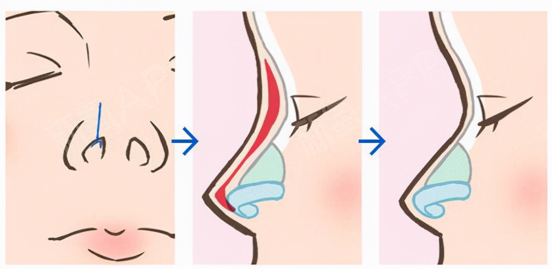 隆鼻术后如何避免感染,隆鼻术后感染吃什么药