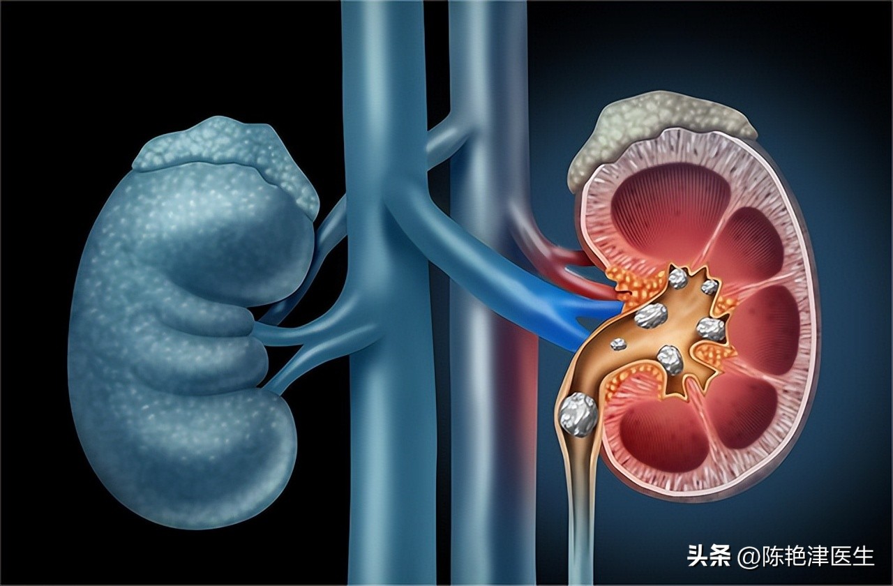体检查出肾结石怎么办？医生：2个方法，或能让肾结石离开身体