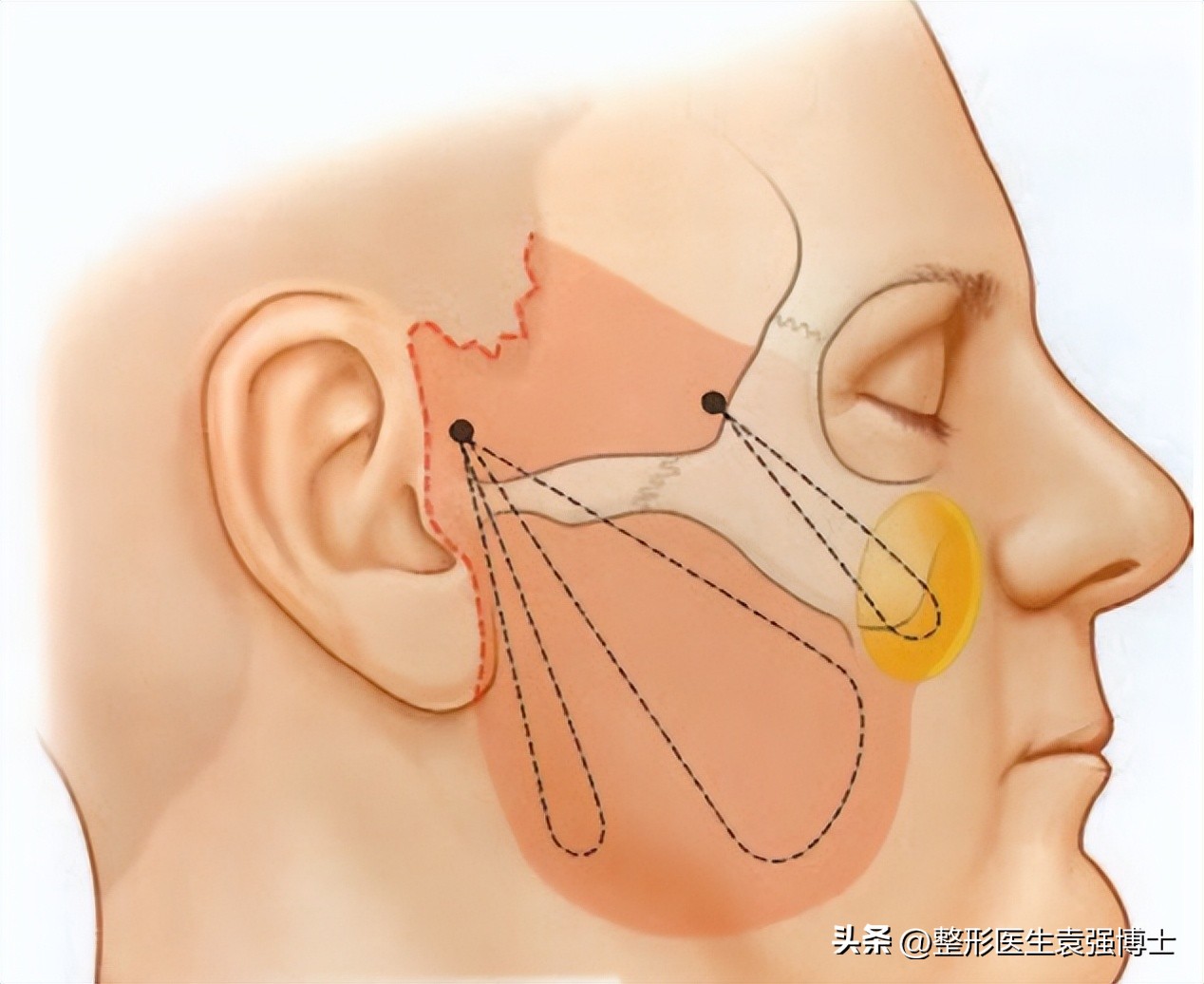 拉皮不剥离会留疤明显吗,拉皮手术如何防止留疤