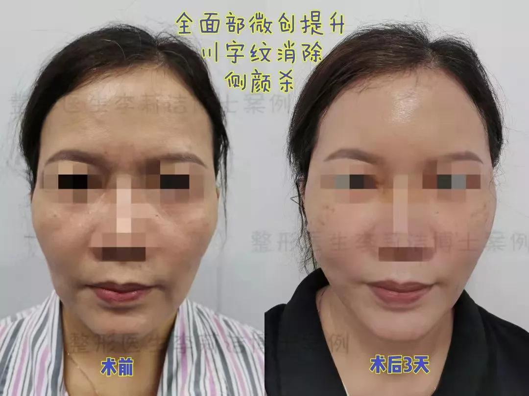 刚做的线雕,刚做线雕后脸上有凹陷正常吗