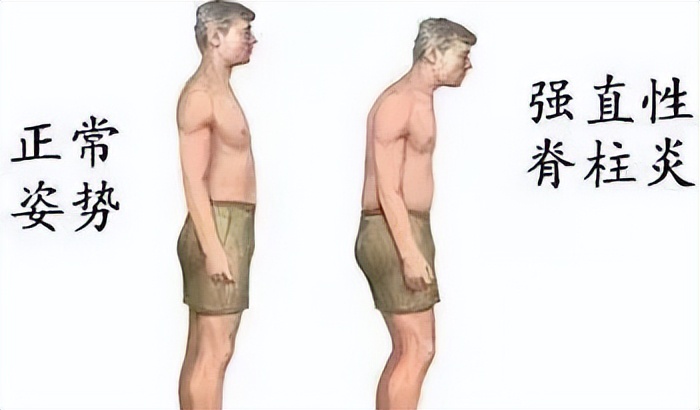 弯腰疼痛当心强直性脊柱炎——市中心医院疼痛科强直性脊柱炎专病门诊开诊