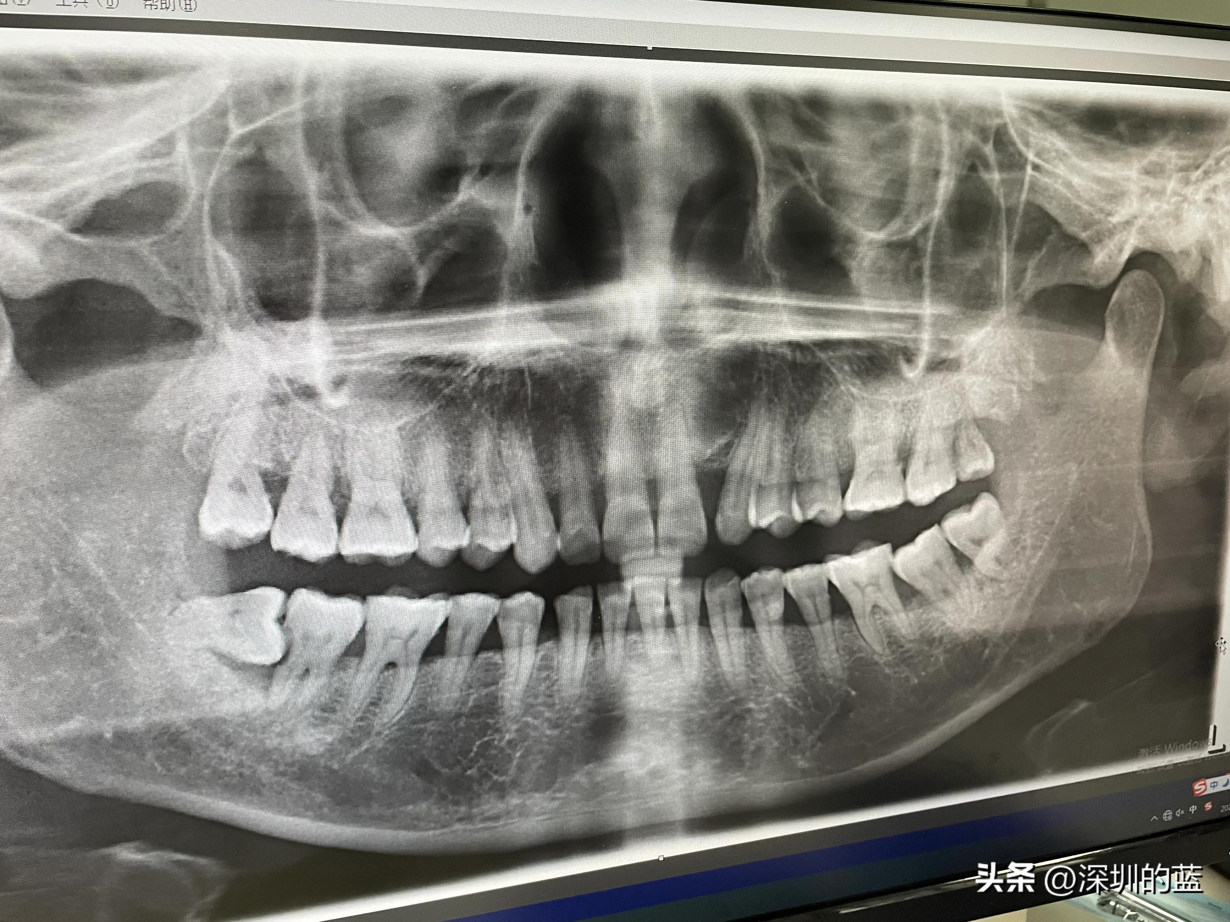 拔除智齿解决了多年的口臭,拔掉四颗智齿意外治好了口臭