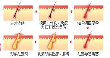 如何区分毛囊炎疖肿和痤疮,疮和疖子怎么区分