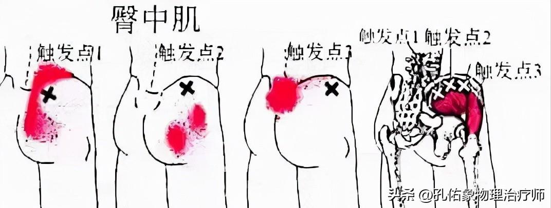 从臀部到小腿麻木疼痛怎么回事,臀部小腿酸胀是怎么回事