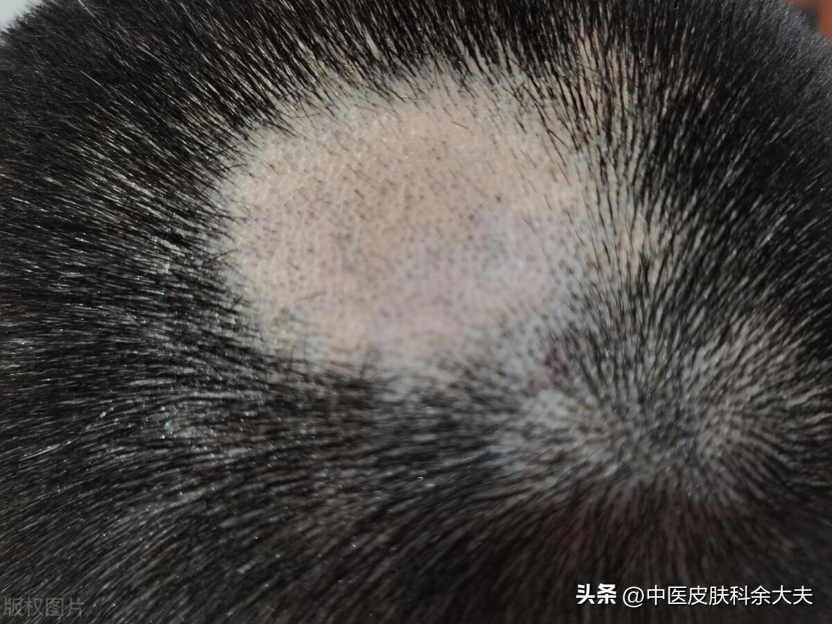 脱发是世界难题,脱发严重时不妨试试以下三招