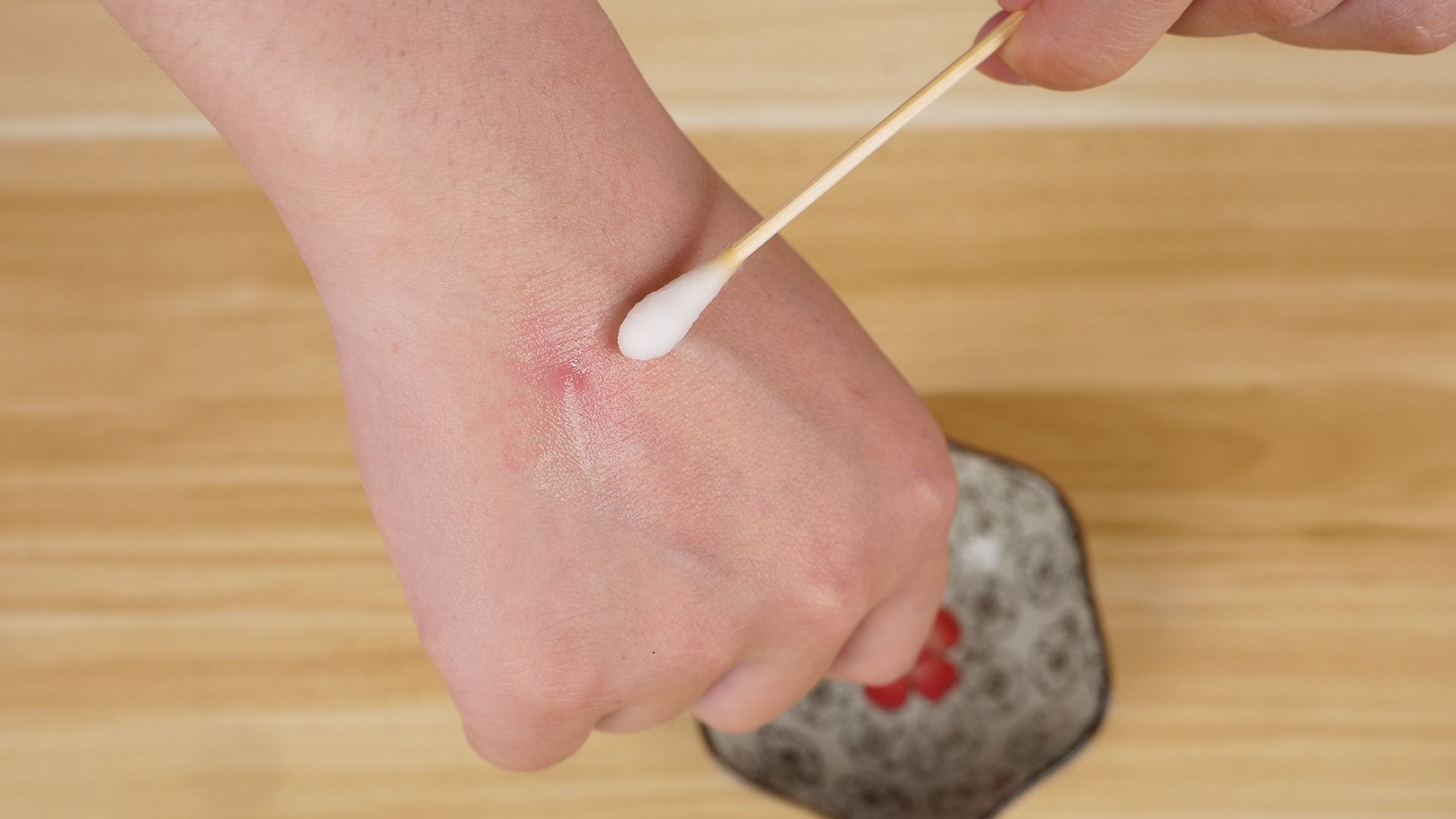 几块钱的红霉素软膏竟能治6种病,红霉素软膏贵的和便宜的区别大吗