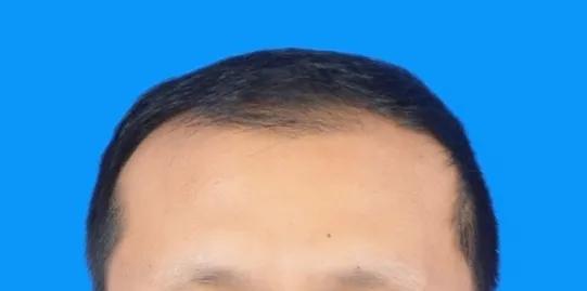 植发的亲身经历和感受,植发1000毛囊真实经历视频