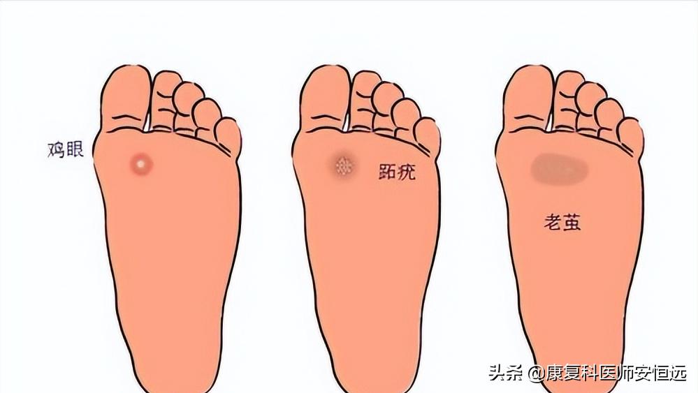 脚底板爱发烫是什么原因,脚底板生茧很疼怎么回事