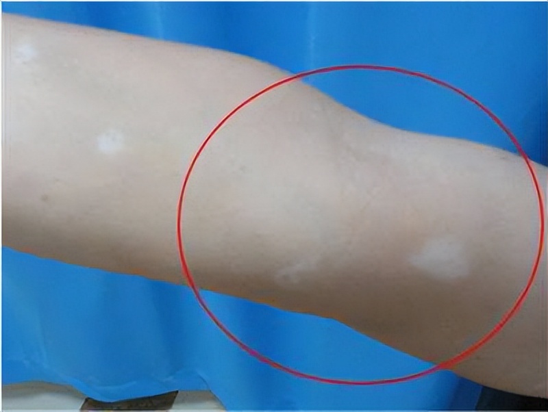 孩子脸上长白斑怎么解释,孩子脸上长白斑一定是白癜风吗